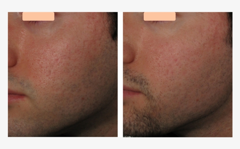 Significant Texture Improvement With Decrease In The - Results After Microneedle Rf, transparent png download