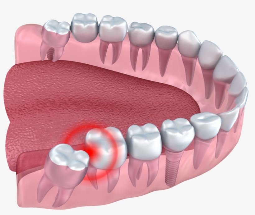 Drawing Of A Set Of Teeth With One Tooth Emerging Into - Wisdom Teeth Png Image Transparent Png Free Download On Seekpng Drawing Of A Set Of Teeth With One Tooth Emerging Into - Wisdom Teeth Png Image Transparent Png Free Download On Seekpng