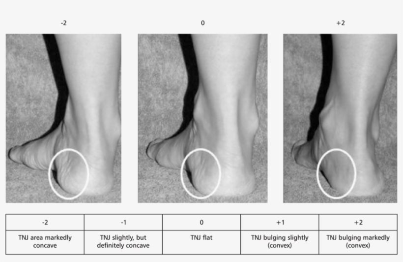 The Evaluation Of Bulging In The Region Of The Talonavicular - Talonavicular Joint, transparent png download