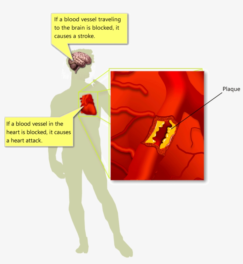 Atherosclerosis - Heart Wall Block, transparent png download