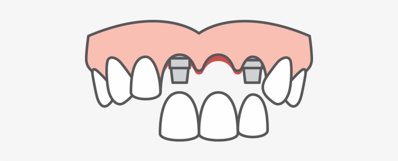 Multiple-tooth Dental Implants Icon - Denture Icon Png, transparent png download