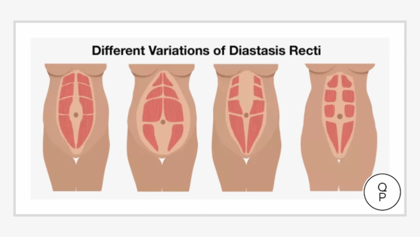 Q Pilates Dra Rectus Diastasis - Muscles Do Sit Ups Work, transparent png download