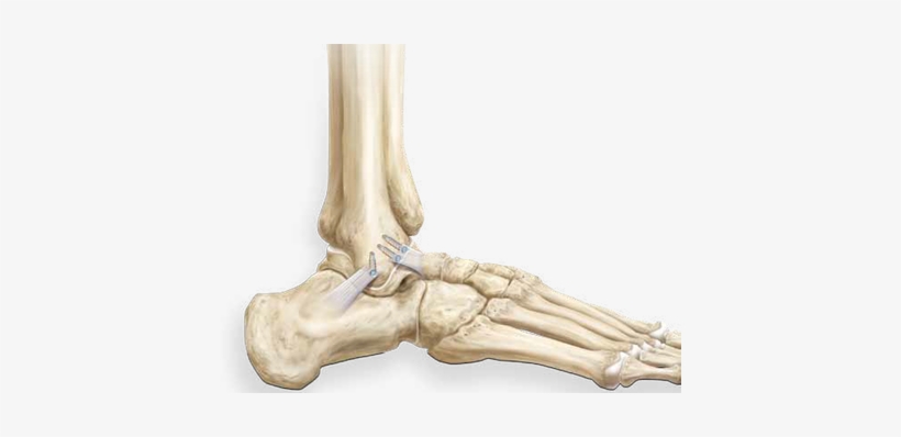 The Divided Ligament Is Then Re-attached To Bone With - Ankle Bone Png, transparent png download