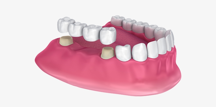 Crowns And Bridges - Crown And Bridge Png, transparent png download