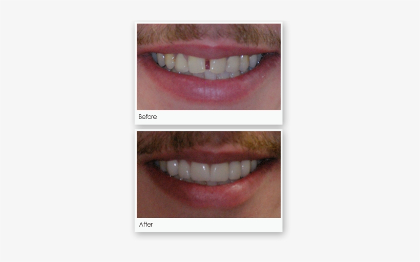 A Dental Bridge Is Custom Made False Tooth Or Teeth - Lieberman Larry T Dds Pa, transparent png download