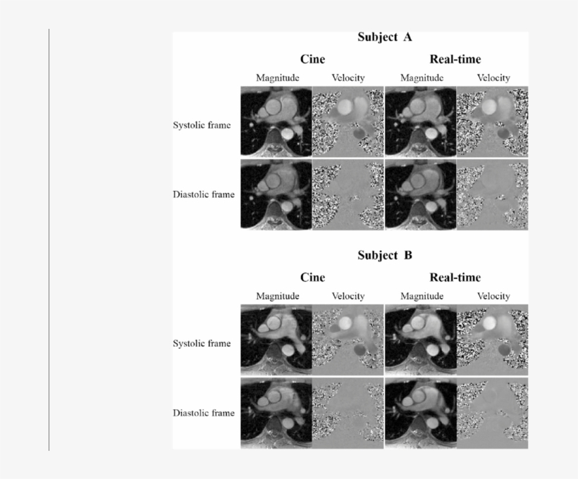 Comparisons Of Real-time Flow Imaging With Cine Flow - Medical Imaging, transparent png download