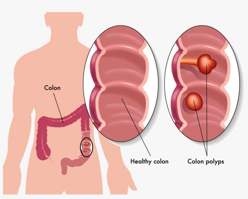 Colon - Imagenes Del Cancer De Colon, transparent png download