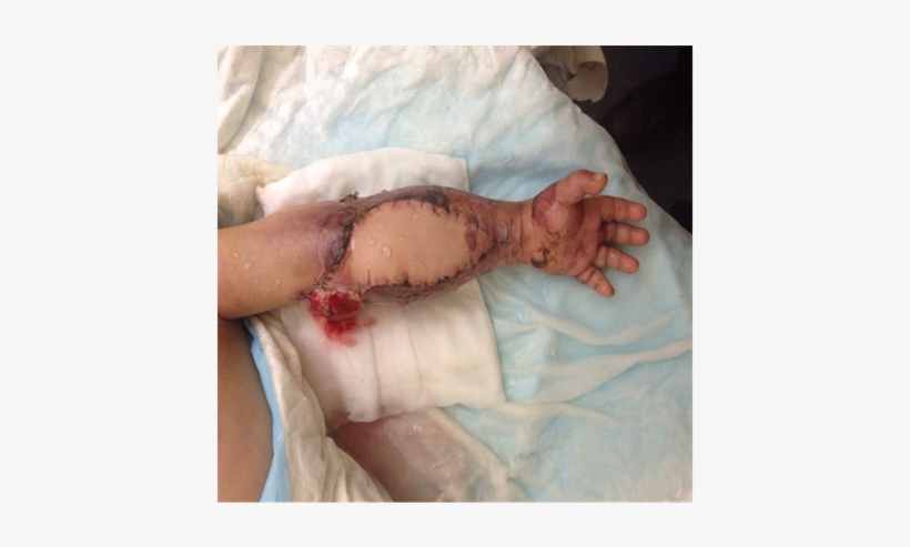Case 3 Immediate Post Op 3 Days, Minimal Debridement - Hand, transparent png download