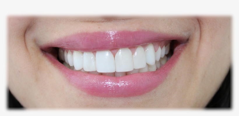 Diseño De Sonrisa - Design, transparent png download