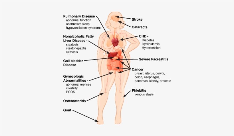 Medical Complications Obesity - Diagram, transparent png download