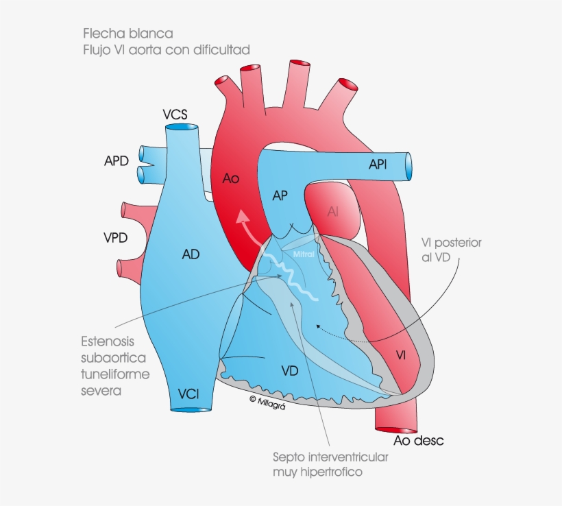 La Estenosis Subaórtica Fibromuscular - Stenosis, transparent png download