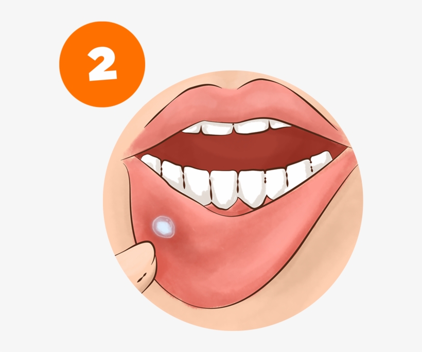 Allow It To Remain On The Area For As Long As Possible - Daktarin Oral Gel Use, transparent png download