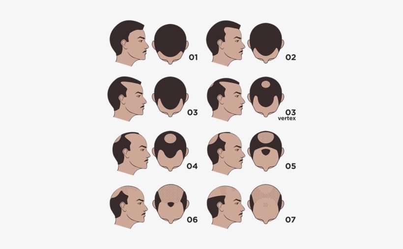 The Only 2 Fda-approved Medications To Combat Hair - Combating Male Pattern Baldness, transparent png download