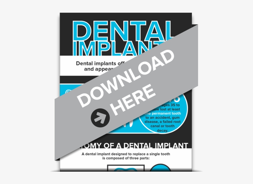 Download Our Free Informative Infographic About Implants - Lonzame Dental Care, transparent png download