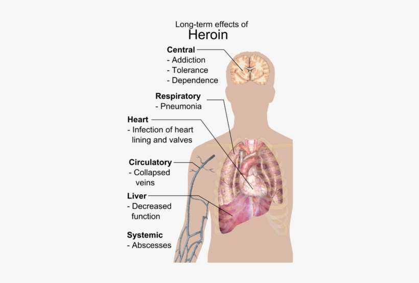 166 × 240 Pixels - Long Term Effects Of Heroin, transparent png download