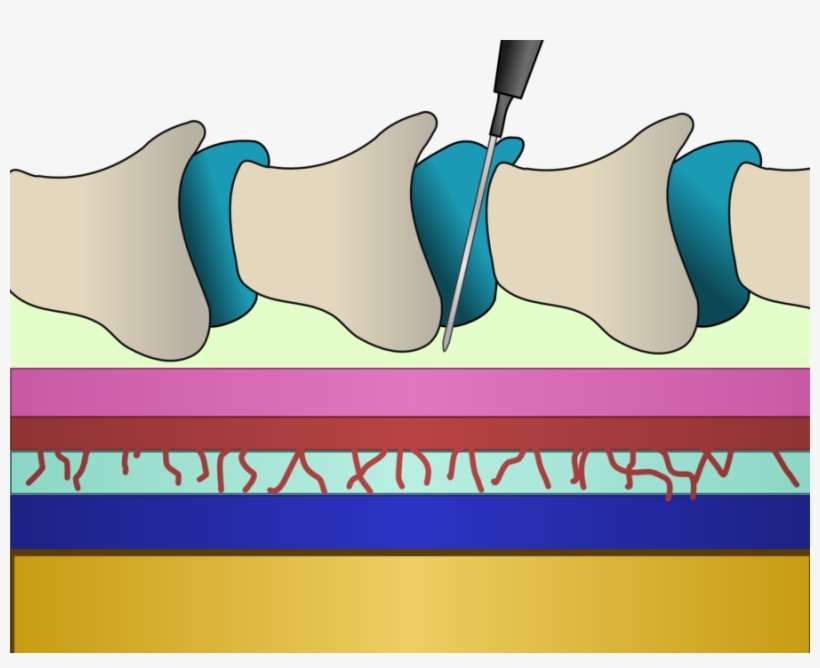 Download Epidural Needle In Back Clipart Back Pain - Znieczulenie W Kręgosłup, transparent png download