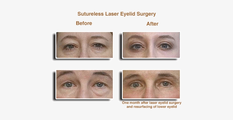 Laser Eyelid Surgery Before & Afters - Eye Laser Surgery Before And After, transparent png download