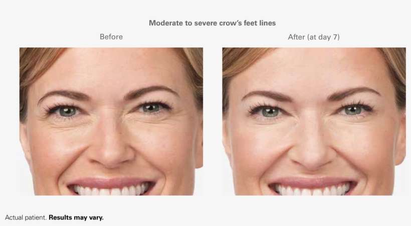 What Is Botox® Cosmetic - Botox Nasolabial Before After, transparent png download