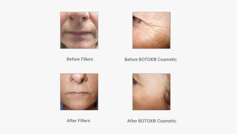 Did You Know An Ophthalmologist Discovered Botox For - Romanoff Vision, transparent png download