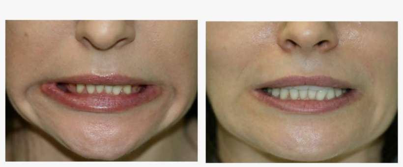 Botox-12 - Close-up, transparent png download