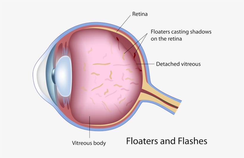 Typically, The Flashes Will Subside After A Few Weeks, - Eye Floaters And Flashes, transparent png download