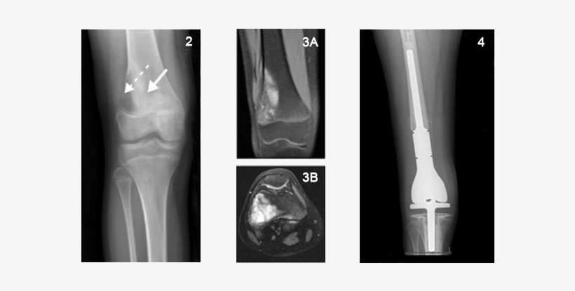 An Mri Scan Better Delineated A Lesion In The Distal - Femur, transparent png download