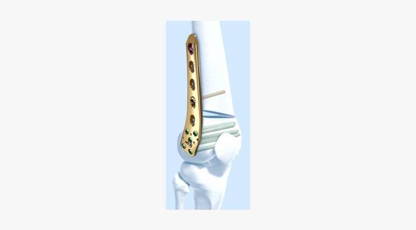 Tomofix Lateral Distal Femur Plate With Screws In Bone - Femur, transparent png download