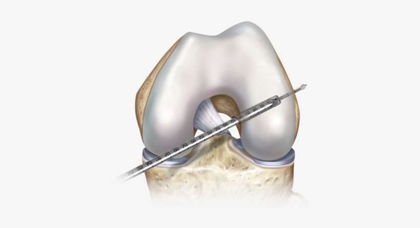 Medial Portal Femoral Socket Preparation 0 Large - Transportal Technique Acl, transparent png download