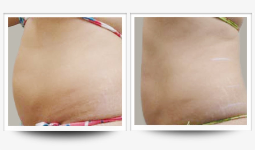 Skin Tightening After 4 Treatments - Medicine, transparent png download