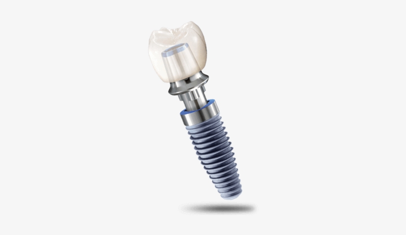 Dental Implant Geelong Dentist Dr Stolz - Dental Implant, transparent png download