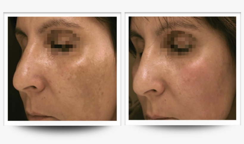 Skin Resurfacing/rejuvenation Courtesy Of Dr - Accent Prime Before And After, transparent png download