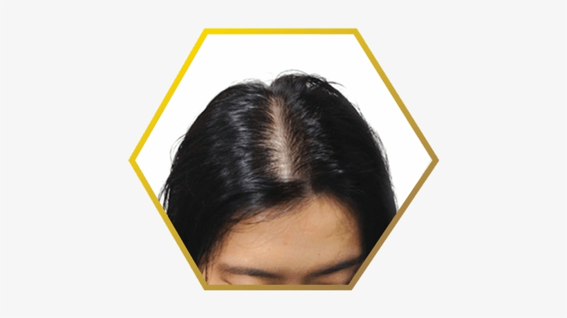 Female Pattern Baldness - Hair Loss, transparent png download