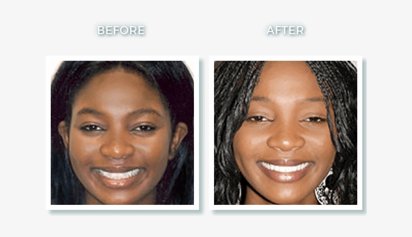 Bolton Ma Dr - People With Invisalign With An Overbite, transparent png download