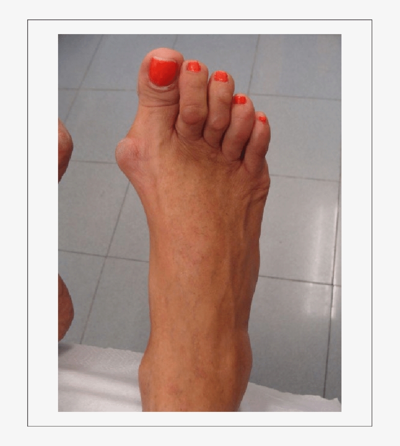 This Figure Shows A Very Common Deformity That Could - Toe, transparent png download