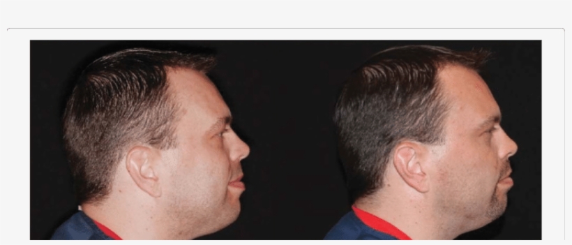 The Changes In Facial Profile And Head Posture In A - Forward Head Posture, transparent png download