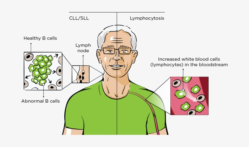 How Imbruvica® Works For Cll/sll - Cll Symptoms, transparent png download