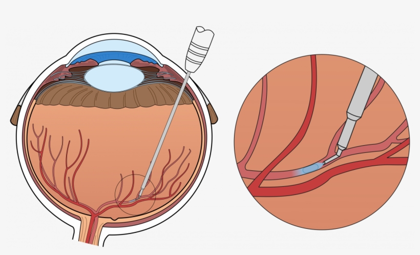 Surgical Eye Robot Performs Precision-injection In - Central Retinal Vein Occlusion Treatment, transparent png download