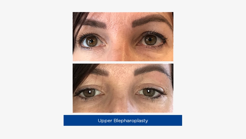 This Is An Amazing Alternative To Laser, It Is Visually - Nottinghamshire, transparent png download