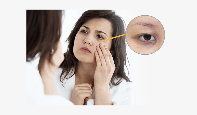 Dark Eye Circles - Periorbital Puffiness, transparent png download