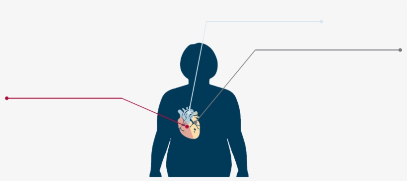 Types Of Obesity Related Heart Disease - Cast A Fishing Line, transparent png download