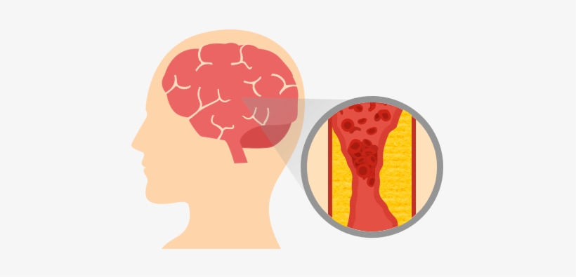 Stroke - Stroke Disease, transparent png download
