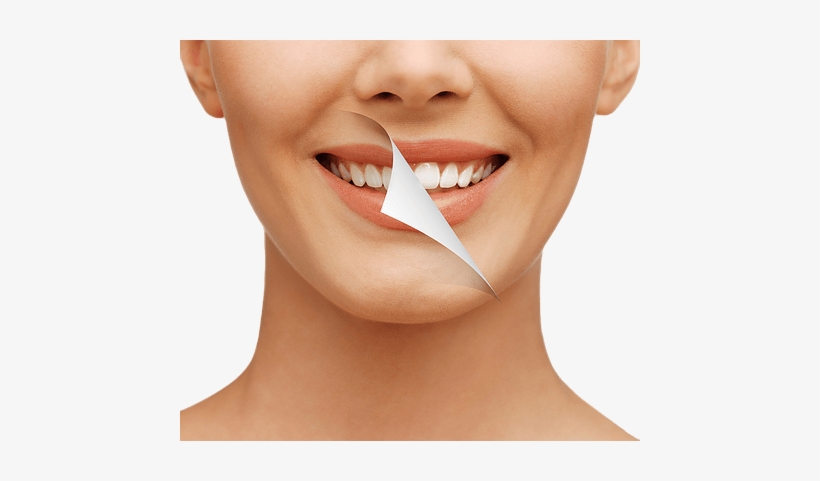 Teeth Restorations In Everett, Wa ~ All Smiles - Get Your Teeth White Again, transparent png download