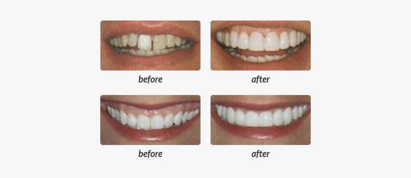 Are You Considering A Complete Smile Makeover - Lumineers, transparent png download