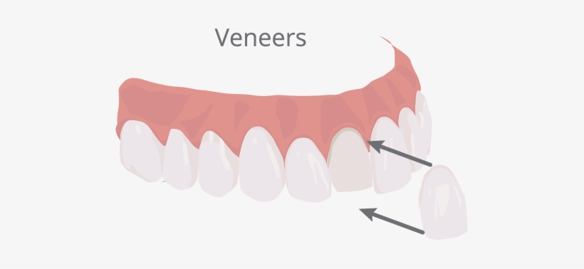 Veneers Illustration - Illustration, transparent png download