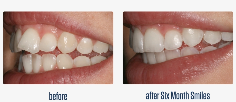 Six Month Smiles Before And After Photo - Six Month Smiles Before And After, transparent png download