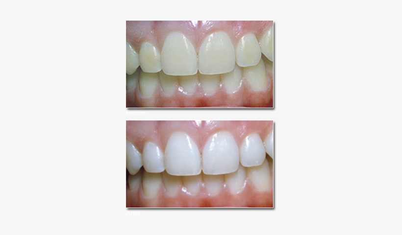 Teeth Whitening Orland Park Dr - Level Of Teeth Whitening, transparent png download