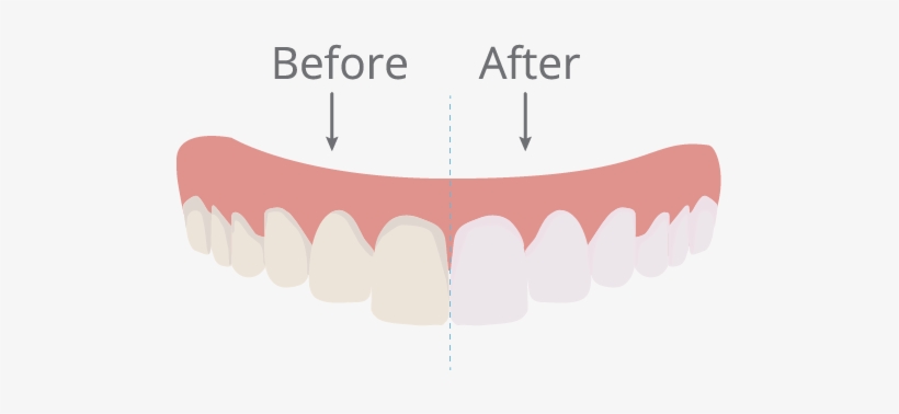 Teeth Whitening For Dansville Patients, transparent png download