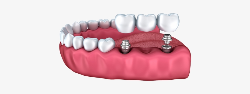 Implantprocedure - Dental Implant, transparent png download