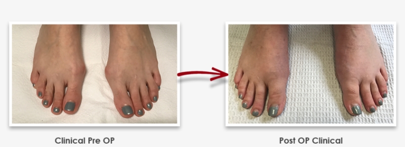 In The Photo Above, His Patient Had Surgery On Both - Toe, transparent png download