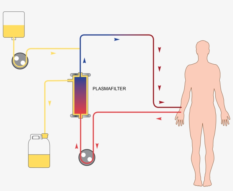 Therapeutic Plasmapheresis Is A Blood Purification - Plasmapheresis Plasma Exchange, transparent png download